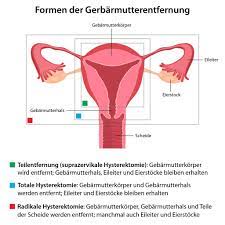 Gebarmutterentfernung Ursachen Ablauf Prognose