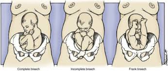 Image result for Breech Delivery