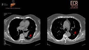 Image result for Broncholithiasis