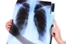 Radio nikosia, maestros en salud mental por experiencia propia. Ou Jeter Une Radiographie