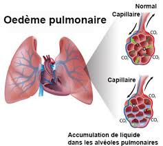 Alvéoles et tissu pulmonaire interstitiel. Oedeme Aigu Du Poumon Oap Symptomes Traitement Definition Docteurclic Com