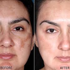 Ndz uv whitening not131204050k hydroquinone perniagaan cahaya hayati. Pin On Mmm