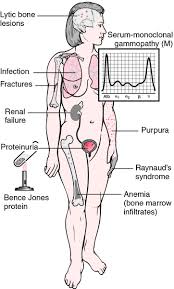 It is a disease of the central nervous system that interferes with nerve impulses from the brain, spinal cord and optic nerves, manifesting in a wide range of symptoms that vary from person to person and are often invisible. Multiple Sclerosis Definition Of Multiple Sclerosis By Medical Dictionary