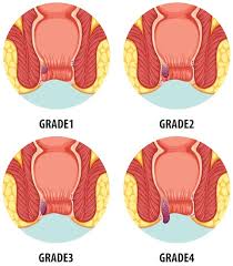 Image result for Hemorrhoid