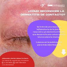 Image result for dermatitis contacta toxica