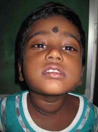 A rare case of solitary toxic nodule in a 3yr old female child