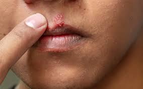 Image result for oral herpes symptoms roof of the mouth