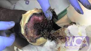 Tita s kitchenette maggots in wounds. Maggot Therapy For Wounds Wound Medicine Medcentris Youtube