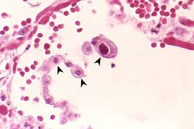 People with a normal immune system are not likely to get infectious esophagitis. Cytomegalovirus Infection Amboss