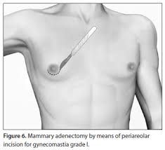 The primary symptom of gynecomastia is an increase in breast size. Scielo Brasil Gynecomastia Physiopathology Evaluation And Treatment Gynecomastia Physiopathology Evaluation And Treatment