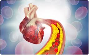 Vamos saber agora o que é aneurisma no coração e qual a sua gravidade. Riscos E Efeitos Secundarios De Stents Do Coracao