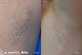 1 here's your guide to evaluating laser hair removal (lhr) for your practice — plus what to look for in devices and the company you partner with. Gentlelase Skin Treatments Laser Hair Removal Pinehurst