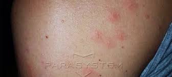 Les réactions peuvent ainsi aller d'une cloque de la taille d'une soucoupe à café à absolument rien en fonction de votre réactivité. Photo Bouton Piqure Punaise De Lit Mgp Animation