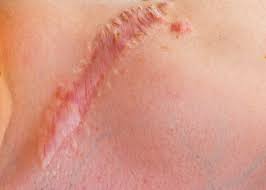 Look for creams and ointments, which are generally more effective than lotions at retaining moisture, and select products that are fragrance free. Cell Type Responsible For Scarring Skin Cancer Growth Identified News Center Stanford Medicine