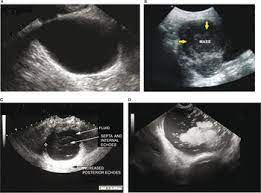 Nonvisualization of the ovaries on pelvic ultrasound: Ultrasound Imaging Of Ovarian Cancer Chapter 22 Ultrasonography In Gynecology