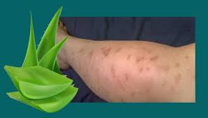Setelah itu, balurkan jus mengkudu ini di bekas luka yang ada di kaki dan bagian tubuh lainnya. Koleksi Gambar Terbaru 2 Cara Menghilangkan Bekas Luka Di Kaki Akibat Gatal Secara Alami