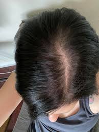 I had no hair issues before spiro. My Hair Loss Story Diagnosis Of Aga 7 Years Ago 200mg Of Spiro Bc For 3 Years No Minoxidil Femalehairloss
