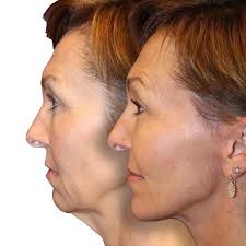 Taking you to the OR with #DiamondDishes! It's always rewarding to see the  lift of the face, neck, jowls come together in real time in the operating  room. Q: Hey Dr. Diamond,