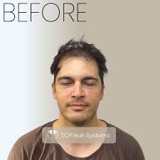 Total Cover Plus Hair System Manchester