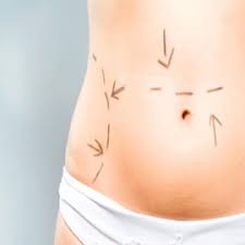 Visceral Fat After Liposuction