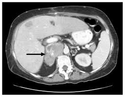 Image result for Leiomyosarcoma