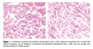Jornal Brasileiro De Pneumologia Mesotelioma Pleural Maligno Experiencia Multidisciplinar Em Hospital Publico Terciario