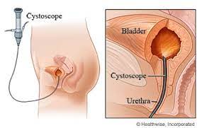 Maybe you would like to learn more about one of these? Https Mydoctor Kaiserpermanente Org Ncal Images Cystoscopy 20before 20your 20procedure Tcm75 457317 Pdf