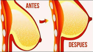 Busto Firme Y Levantado Como Hacer Un Brassier En Gel Frio Reafirmar Los Senos Caidos Youtube