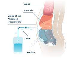6way reduce water fluid retention in stomach and body |water retention weight gain|water retention 6way remove fluid from body and stomach. Paracentesis Procedure Offers Mesothelioma Symptom Relief