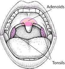 One of the major differences between the two infections is that; Enlarged Tonsils And Adenoids In Children Children S Health Issues Msd Manual Consumer Version
