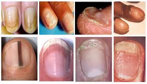 Selon les causes, elles peuvent concerner un ou plusieurs ongles, en totalité ou en partie, ou former des. Ongles Ondules Ou Bombes Decouvrez Ce Que Les Anomalies Des Ongles Revelent Sur Votre Sante Alnas Fr