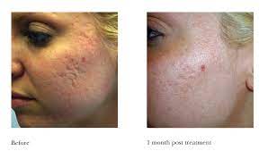 We also specialize in facials, skin rejuvenation, botox & juvederm treatments, spider vein therapy, sun & age spot removal, as well as chemical peels and facials. Laser Aesthetics Hawaii