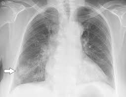 Lung cancer develops due to the overgrowth of. Abnormal Chest X Ray What Is It Symptoms Causes Prevention And Treatment Top Doctors