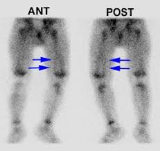 Image result for Osteomyelitis Bone Scan