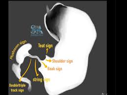 Hypertrophic pyloric stenosis illustrations showing USG measurements and  barium study signs. Save to refer them before you see your next case. #art  #rad #radiology #procreate #ipad #neet #neetpg #anatomy #usg #barium  #radiotech #