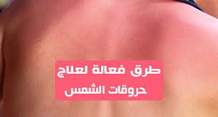 كلنا نريد التمتع ببعض اشعة الشمس او قضاء بعض الأيام في الشواطئ للاستمتاع وامتصاص أشعة الشمس لاكن الشيء الذي قد لا تلقي له بالا هو انك قد تتعرض لأشعة الشمس بشكل