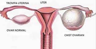 Maybe you would like to learn more about one of these? Chisturi Ovariene Tratamente Naturiste Si Remedii In