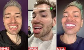 Man leaves TikTok users shocked after getting budget teeth shaving in  Turkey
