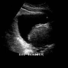 Wk 6 Prostate Benign Prostatic Hypertrophy Radiology Reference Articl Benign Prostatic Hypertrophy Benign Prostatic Hyperplasia Diagnostic Medical Sonography
