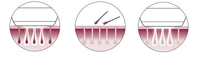 How does laser hair removal work? How Is Philips Lumea Different From Professional Hair Removal Treatment Philips