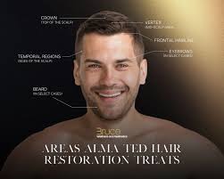 Alma TED Hair Restoration in Cary, NC