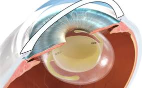 Merhaba arkadaşlar ben sürekli bu tarz işlerle uğraşıyorum ve yaptığım maketlerden hep artan parçalardan yeni maketler çıkarıyorum malzemelerimin hepsi evde bulanan malzemeler hamurlarım,evde bulunan yarım guaj boyalar. Katarakt Ameliyati Ankara Fiyatlari 2021 Prof Dr Yonca Akova