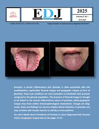 Image result for Fissured tongue