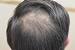 Diffuse Thinning Buzz Cut