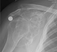 Image result for Chondrosarcoma