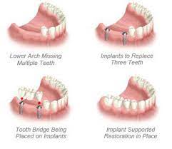 Maybe you would like to learn more about one of these? Valencia Periodontics Replacing Multiple Teeth