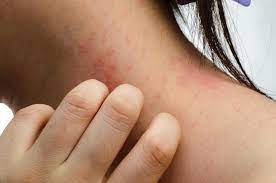 Hair Dye Allergy Reactions Symptoms And Treatments Severe Eczema Eczema Diet How To Treat Eczema