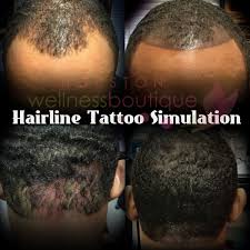 Pin On Scalp Micropigmentation