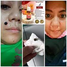 Cara menghilangkan tahi lalat mati di bibir dan pipi. Minyak Bulus Asli Obat Penghilang Tahilalat Ampuh Obat Penghilang Tahilalat Di Muka Obat Penghilang Tahilalat Hidup Obat Penghilang Tahilalat Bpom Obat Penghilang Kutil Dileher Obat Penghilang