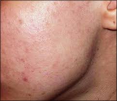 Isotretinoin may also be used for purposes not listed in this medication guide. Diagnosis And Treatment Of Acne American Family Physician